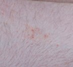 Bed bug bite on human skin